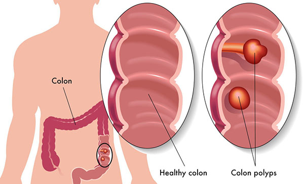 nguyen-nhan-bi-polyp-dai-trang